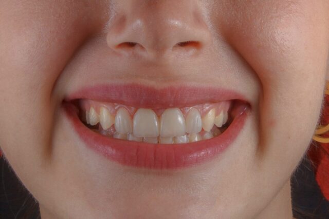 Dents plus blanches sans blanchiment : la routine à 3 minutes